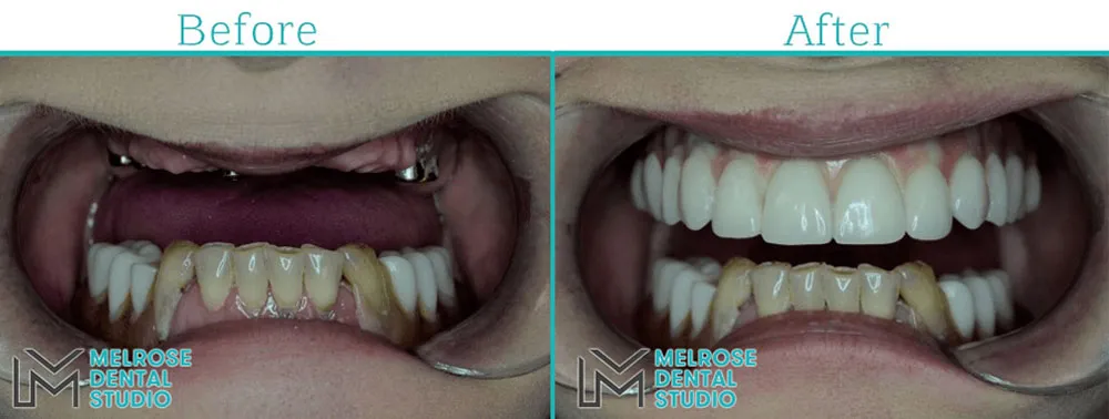 Before and after of a smile restored with Nobel Biocare dental implants, case 1